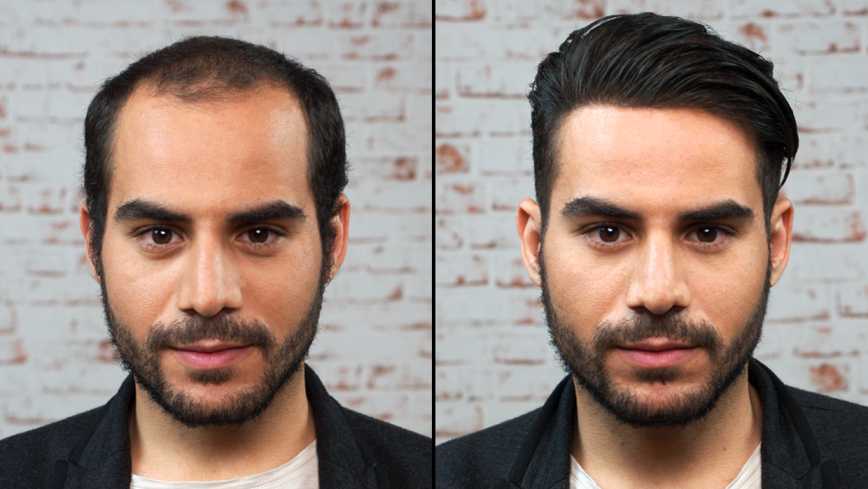 Androgenic Aloepaecia & Aerretta